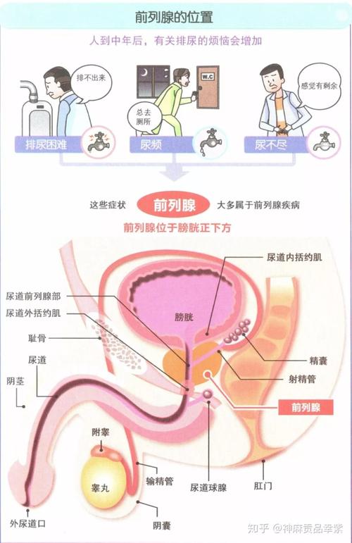 (1)前列腺疾病造成的泌尿系统炎性刺激