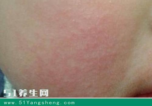 感染了病毒性肝炎,有1/5～1/3的人可能发生皮疹,常见的有红斑,斑丘疹