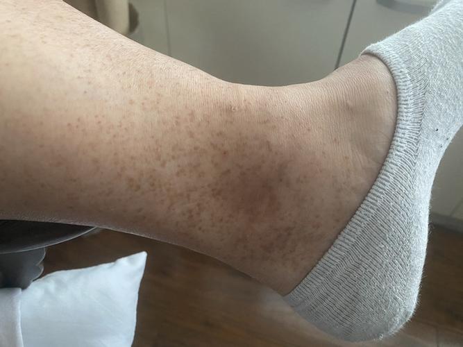 脚踝部晒印怎么消除?