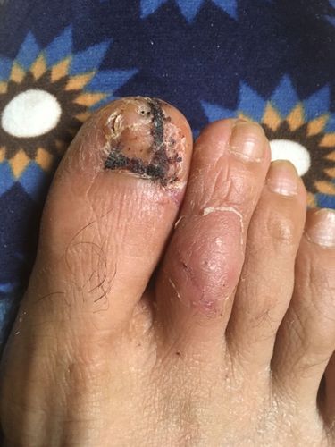 工伤大脚趾开放性骨折,指尖骨头取出五毫米,指甲拔了.