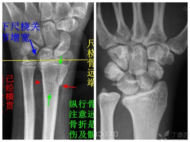 找一个园子里的正位片,对照一下尺桡骨远端的大致关系.