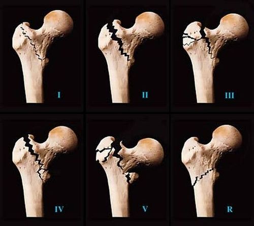 股骨近端有大粗隆(也叫大转子)和小粗隆(也叫小转子),骨折发生在两者