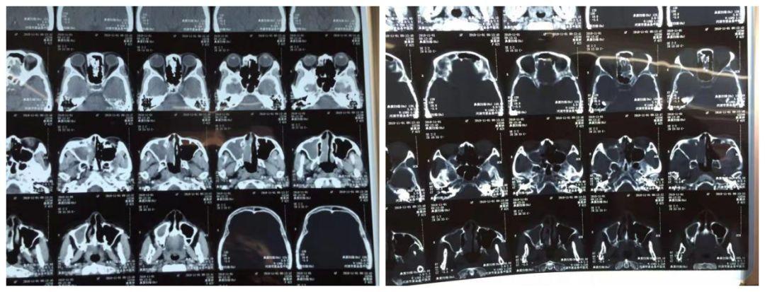 检查后发现患者右侧鼻腔总鼻道长满淡红色肿物,遂完善鼻窦ct检查,发现