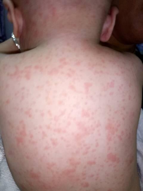 幼儿发烧后与皮疹的关系!