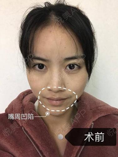 填充改善嘴周凹陷也能看着年轻十岁