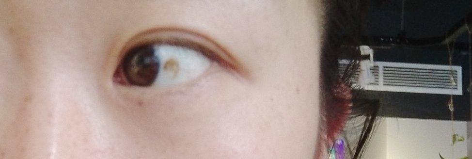 眼睛里不知道是不是黄斑?