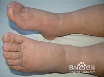 分为心源性水肿,肾源性水肿,肝源性水肿,营养不良性水肿,粘液性水肿