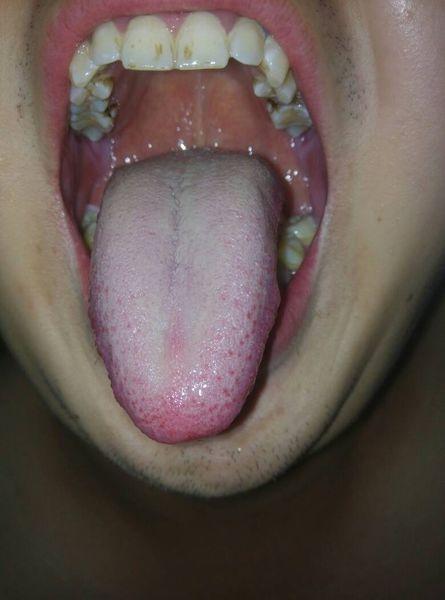我的舌头是白白色念珠菌感染么?求专家,我口唇干,嘴里