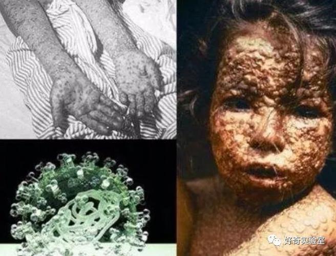 最后的天花病毒该销毁还是保存?俄罗斯实验室爆炸起火