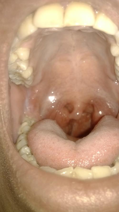 扁条体右侧喉咙上长了一个肉疙瘩,不痛不痒也没有异物