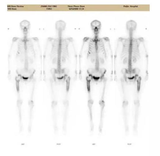 骨扫描和pet-ct显像的注意事项