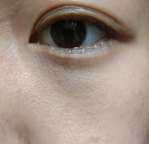 这是毛周角化,简单3步就能消除!