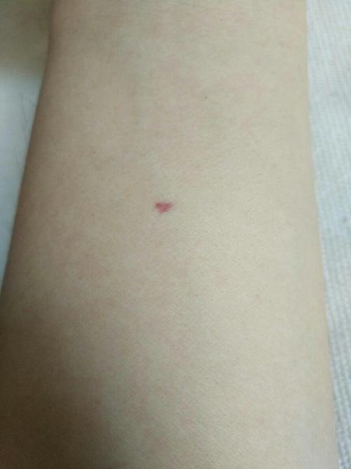 胳膊上有红点是得什么病了吗?