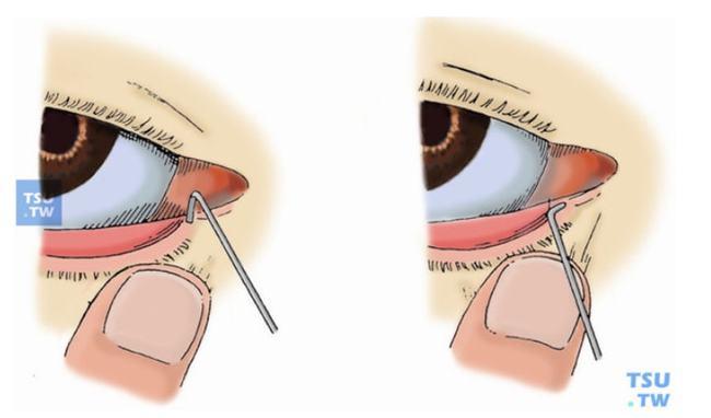 泪道探通手术探通前让宝宝禁食,水1小时.