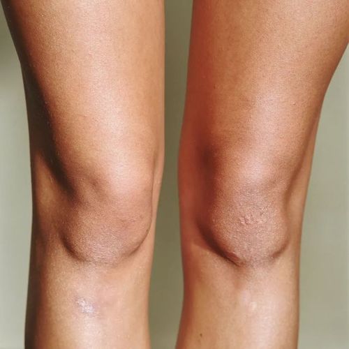 科普一下静脉曲张的初期症状有哪些,避免您错过最佳