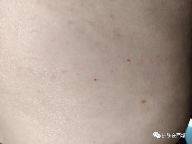 身上的小红点是什么?_皮肤
