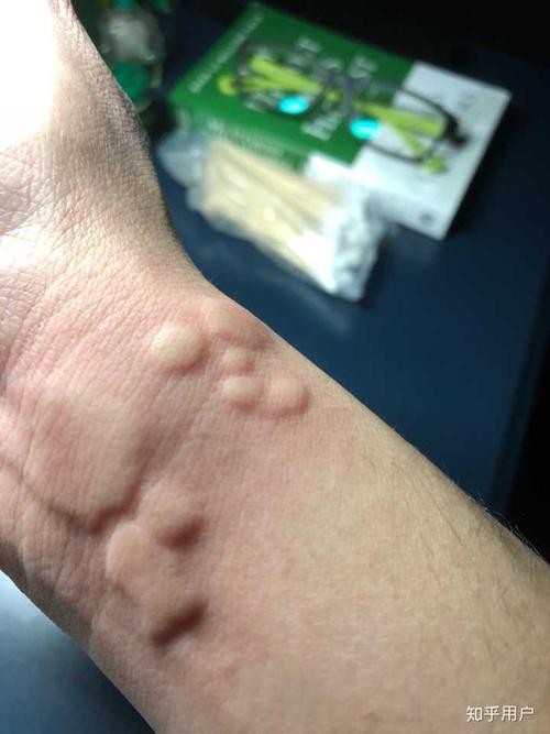 有没有小伙伴和我一样的荨麻疹症状,上图?