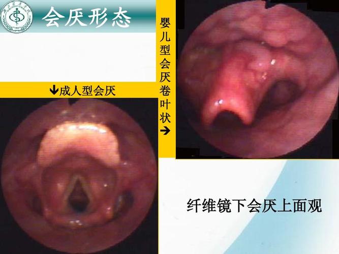 成人型会厌 婴 儿 型 会 厌 卷 叶 状   纤维镜下会厌上面观