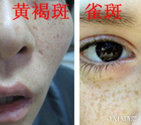 【图】黄褐斑和雀斑区别图片展示 11个特征帮你有效对症下药