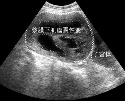 子宫肌瘤变性什么意思