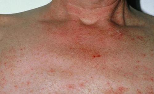 27岁小伙全身长满蜘蛛痣,医生:不忍直视,肝硬化跑不掉了