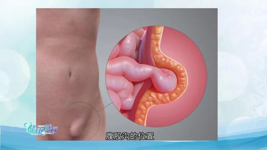 健康随行丨勿以"疝"小而不为|疝气|健康随行_新浪新闻