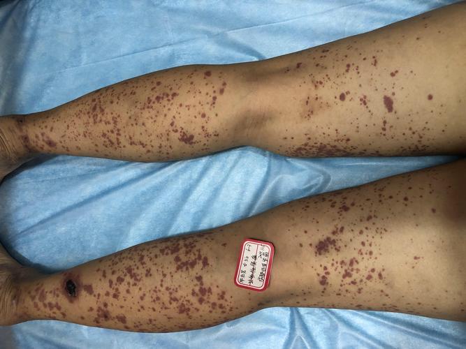 儿童紫癜肾炎症状有哪些?_血小板