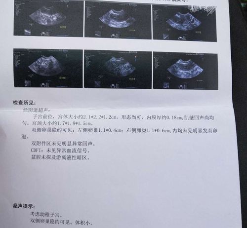 幼稚子宫子宫偏小b超报告单