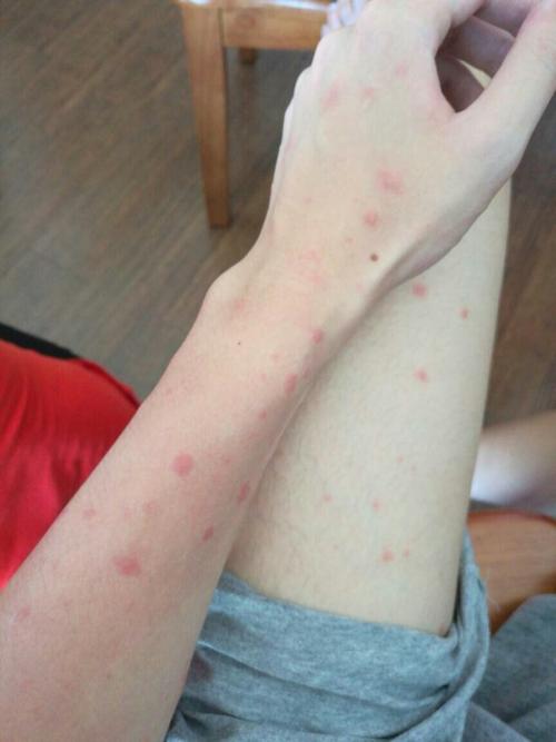 男,长水痘有4 天了,没有发烧也没有化脓",就是不停的出小红点,这是