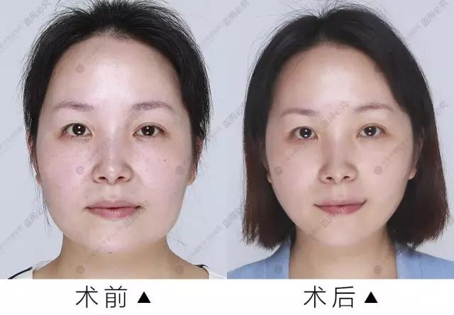 华美紫馨·线雕提拉术效果图