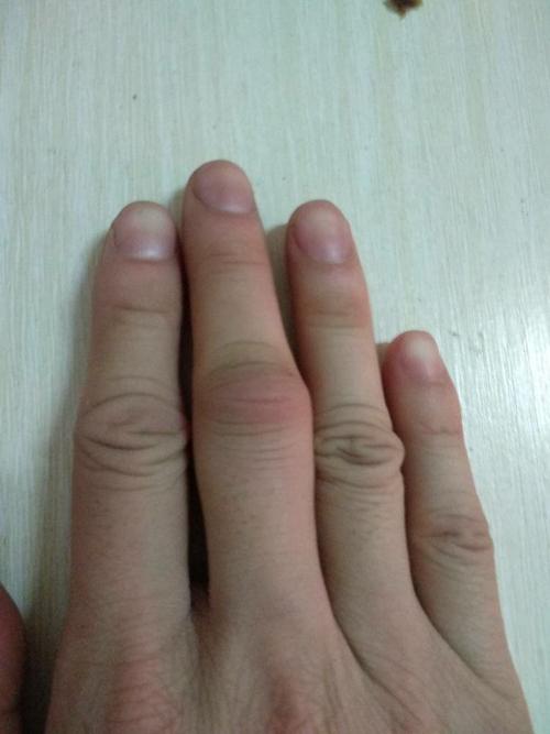手指关节肿了很痛