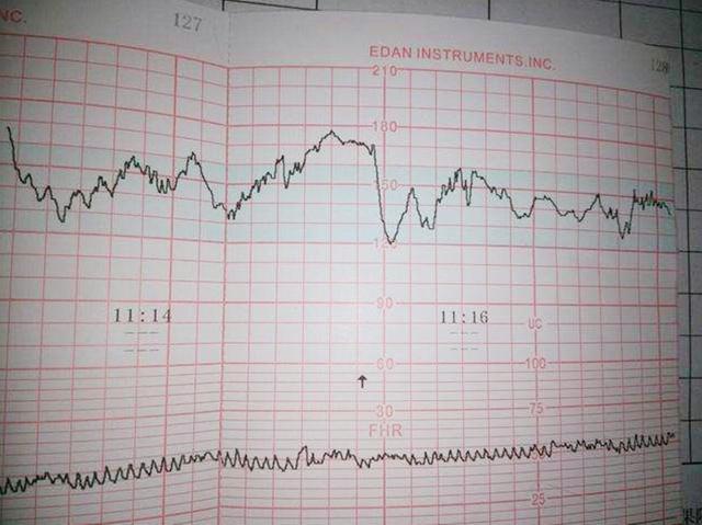 胎心监护图怎么看?这几个数据看懂,自己就能了解胎儿