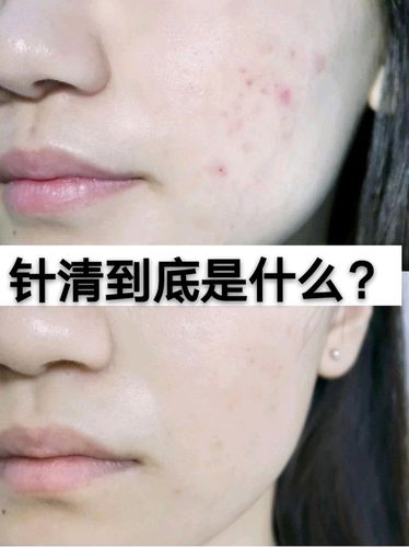 祛痘,那么针清到底是什么