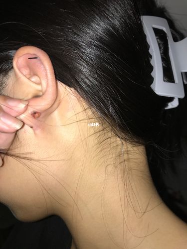 耳洞周围长脓包怎么办_耳洞_医疗健康_医疗健康其他