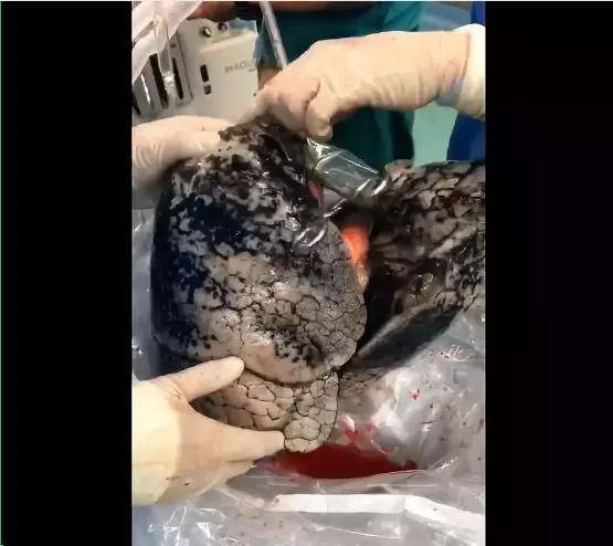 "8岁女孩肺癌晚期,真相竟是孩子被迫吸了2040根烟?