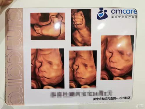 24周~四维彩超的超完美体验