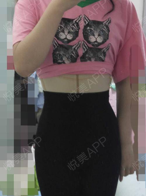 腰腹环吸术后快两周了,给大家做个反馈,现在也不怎么.