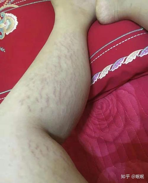 困扰我多年的肥胖纹终于解决了