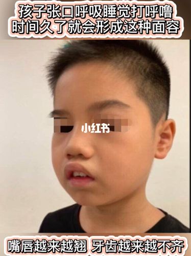 孩子张口呼吸,最后嘴唇变翘,形成这种腺样体面容 只能