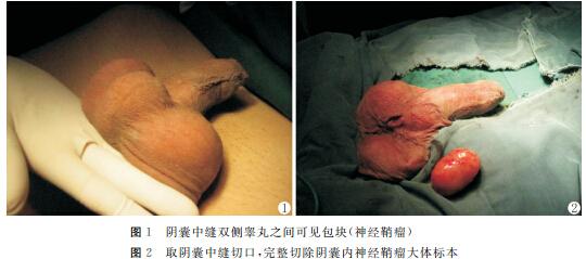 阴囊内神经鞘瘤1例