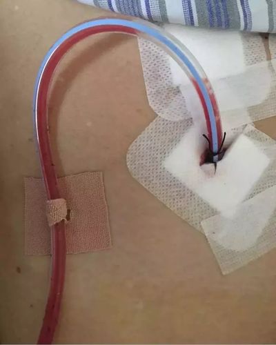 肝胆手术后引流管的护理