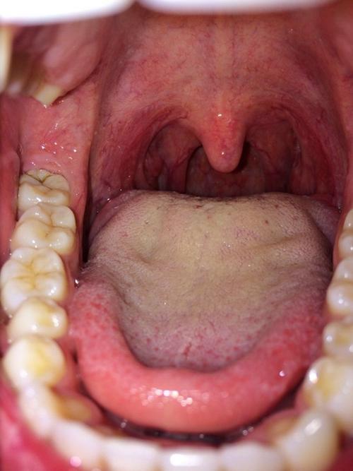 正常人的扁桃体图片