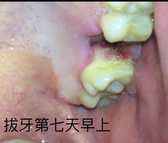 拔牙全程(多图慎点!)恢复期全过程
