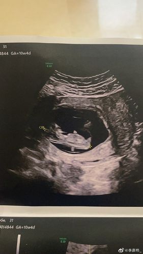 李嘉格晒b超照宣布怀二胎和车澈又约了个小天使