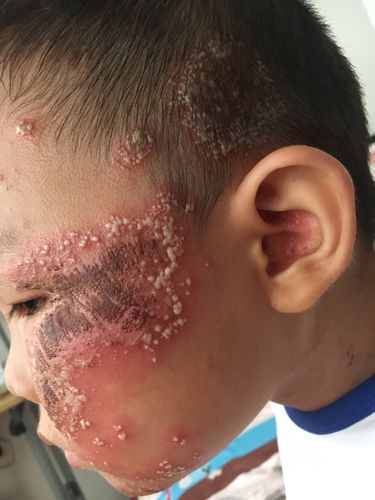 脓包型银肖病时分严重在新华医院看要住院但是床位没有怎么办