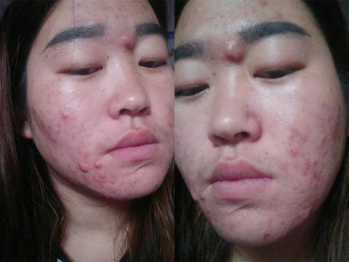 痘痘红肿硬块,一个方法快速去除_面部