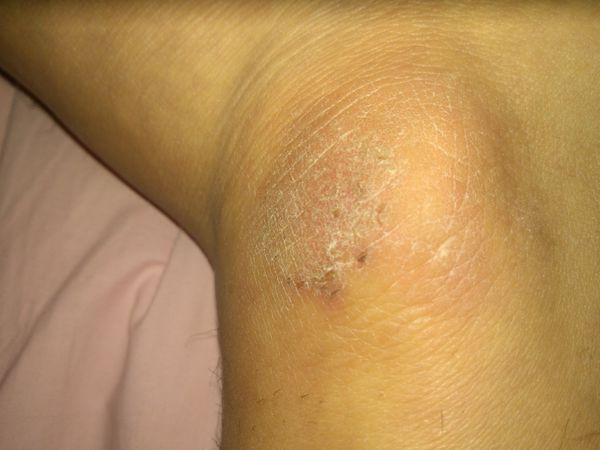 我右脚脚踝上长了一片像藓一样的东西,皮肤