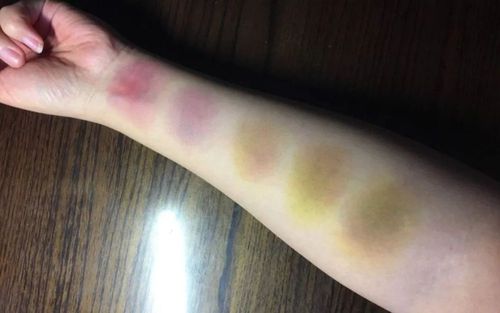 身体经常莫名出现淤青?这是身体在"报警"!