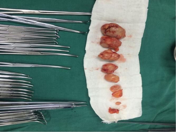 双环法治疗乳腺多发纤维腺瘤