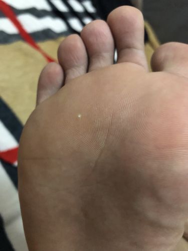 前脚掌长了一个倒刺